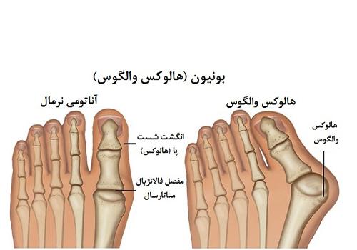 علت ایجاد انحراف انگشت پا یا هالوکس والگوس 